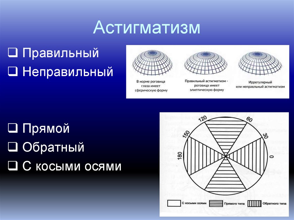 Астигматизм