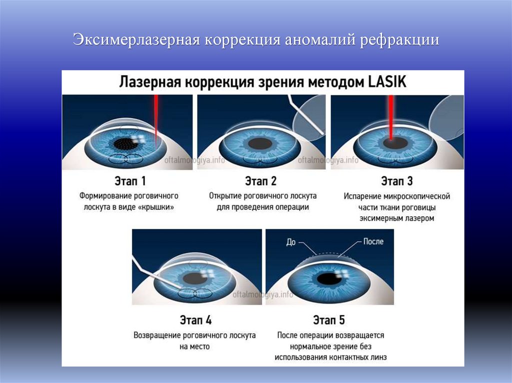 Эксимерлазерная коррекция аномалий рефракции