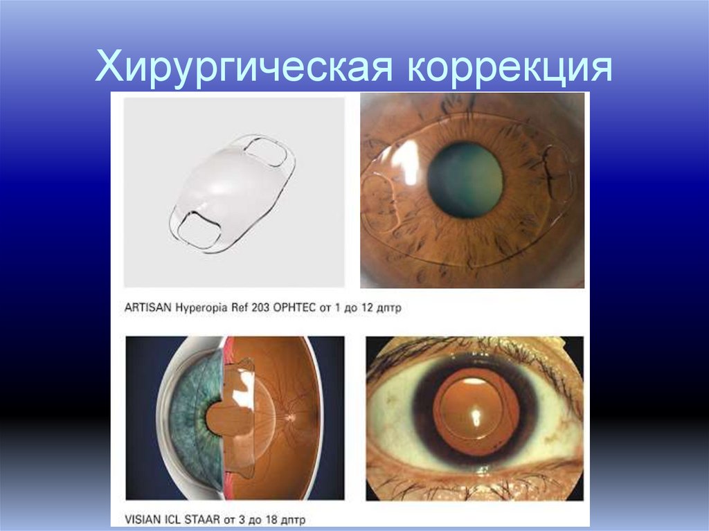 Хирургическая коррекция