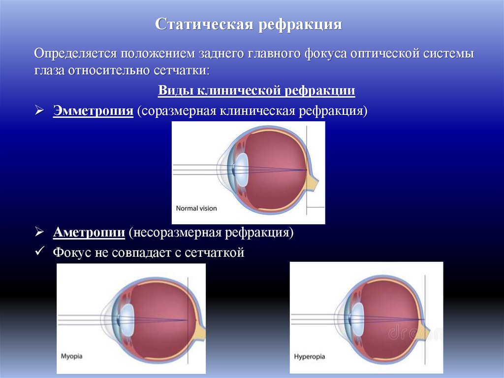 Статическая рефракция