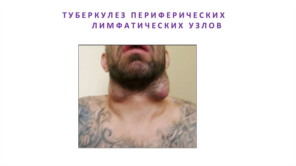 ТУБЕРКУЛЕЗ ПЕРИФЕРИЧЕСКИХ ЛИМФАТИЧЕСКИХ УЗЛОВ
