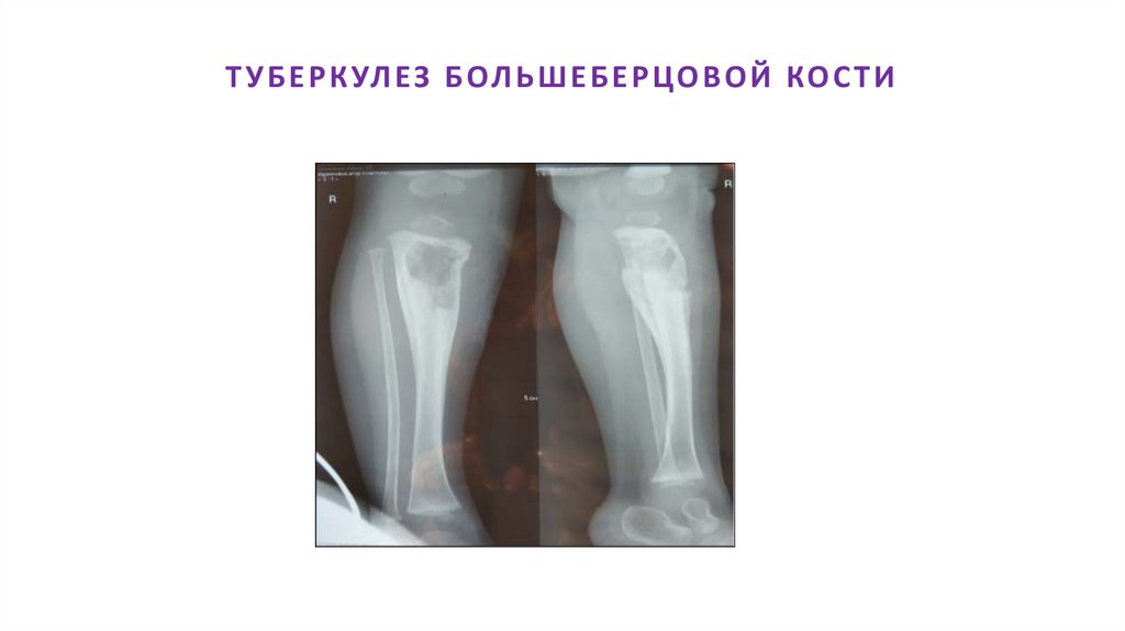 ТУБЕРКУЛЕЗ БОЛЬШЕБЕРЦОВОЙ КОСТИ