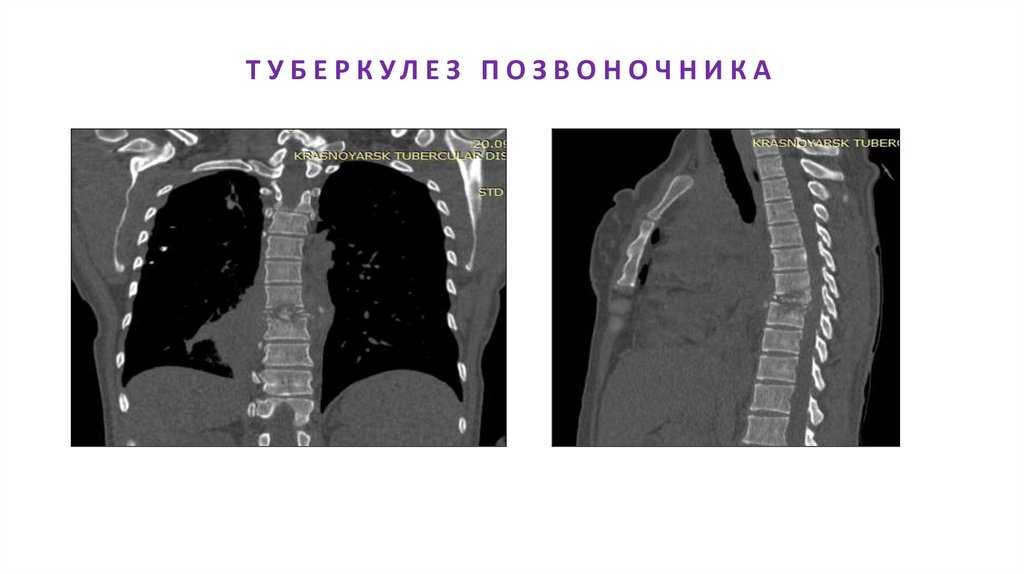 ТУБЕРКУЛЕЗ ПОЗВОНОЧНИКА
