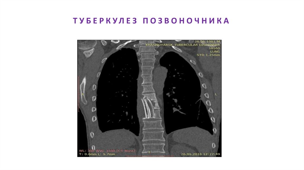 ТУБЕРКУЛЕЗ ПОЗВОНОЧНИКА