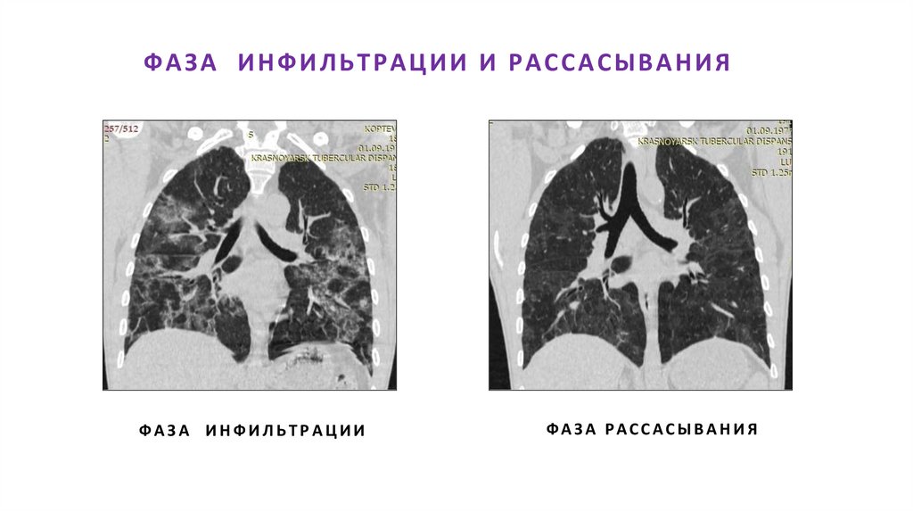 ФАЗА ИНФИЛЬТРАЦИИ И РАССАСЫВАНИЯ