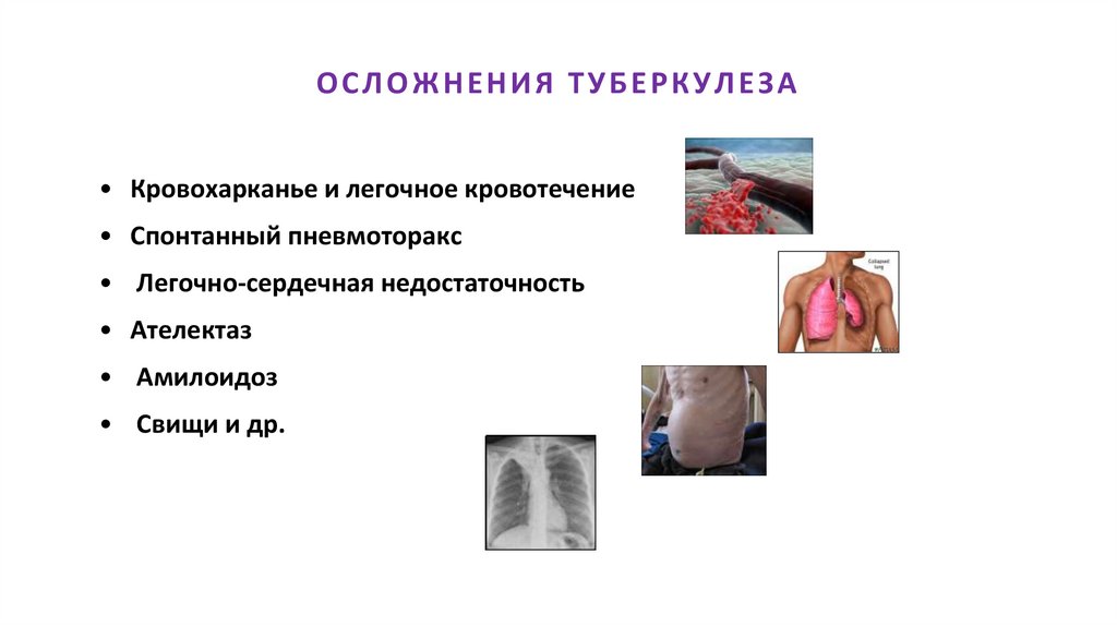 ОСЛОЖНЕНИЯ ТУБЕРКУЛЕЗА