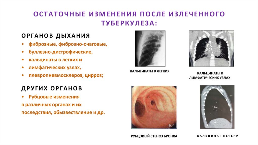 ОСТАТОЧНЫЕ ИЗМЕНЕНИЯ ПОСЛЕ ИЗЛЕЧЕННОГО ТУБЕРКУЛЕЗА: