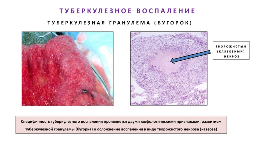 ТУБЕРКУЛЕЗНОЕ ВОСПАЛЕНИЕ