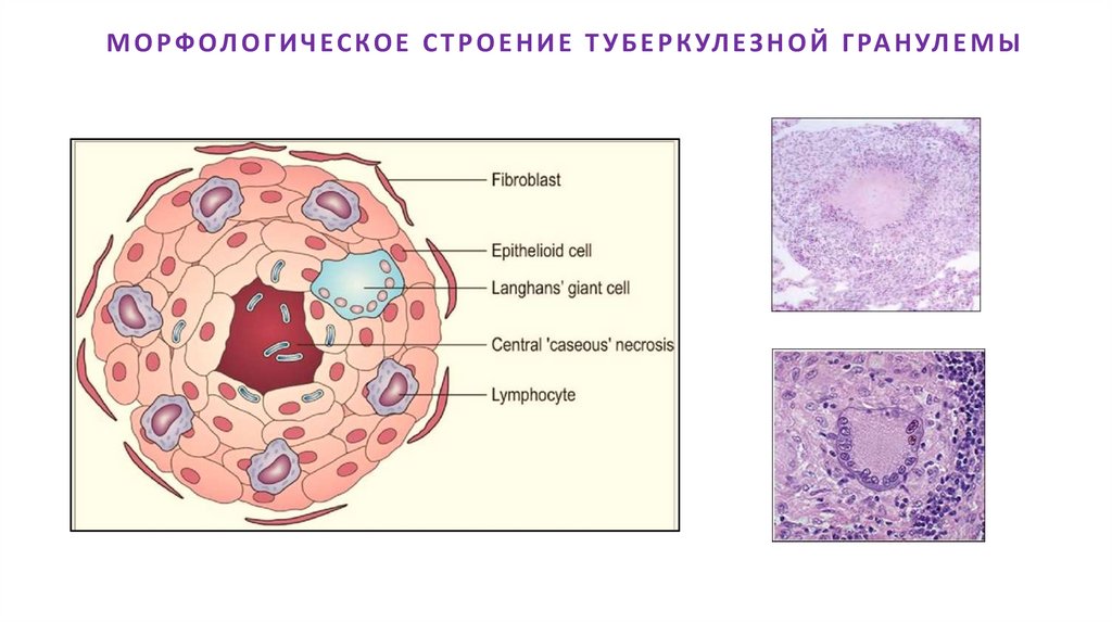 МОРФОЛОГИЧЕСКОЕ СТРОЕНИЕ ТУБЕРКУЛЕЗНОЙ ГРАНУЛЕМЫ