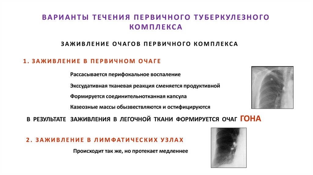 ВАРИАНТЫ ТЕЧЕНИЯ ПЕРВИЧНОГО ТУБЕРКУЛЕЗНОГО КОМПЛЕКСА