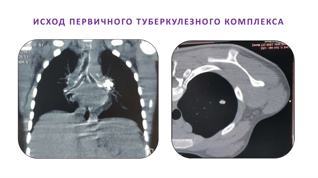 ИСХОД ПЕРВИЧНОГО ТУБЕРКУЛЕЗНОГО КОМПЛЕКСА