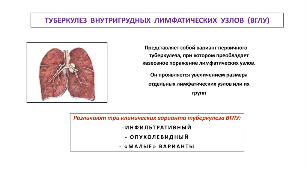 ТУБЕРКУЛЕЗ ВНУТРИГРУДНЫХ ЛИМФАТИЧЕСКИХ УЗЛОВ (ВГЛУ)