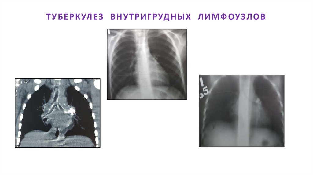 ТУБЕРКУЛЕЗ ВНУТРИГРУДНЫХ ЛИМФОУЗЛОВ