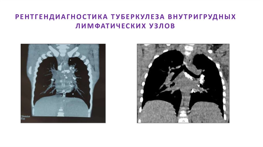 РЕНТГЕНДИАГНОСТИКА ТУБЕРКУЛЕЗА ВНУТРИГРУДНЫХ ЛИМФАТИЧЕСКИХ УЗЛОВ
