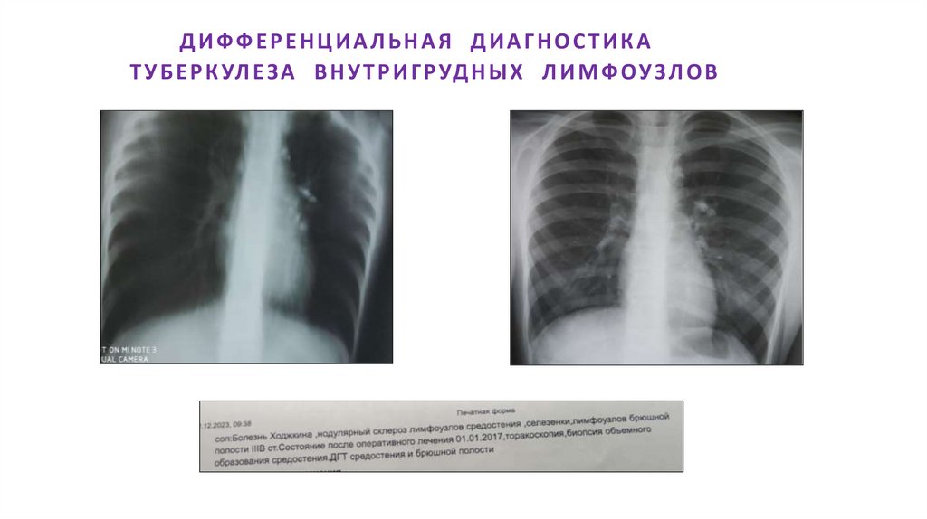 ДИФФЕРЕНЦИАЛЬНАЯ ДИАГНОСТИКА ТУБЕРКУЛЕЗА ВНУТРИГРУДНЫХ ЛИМФОУЗЛОВ