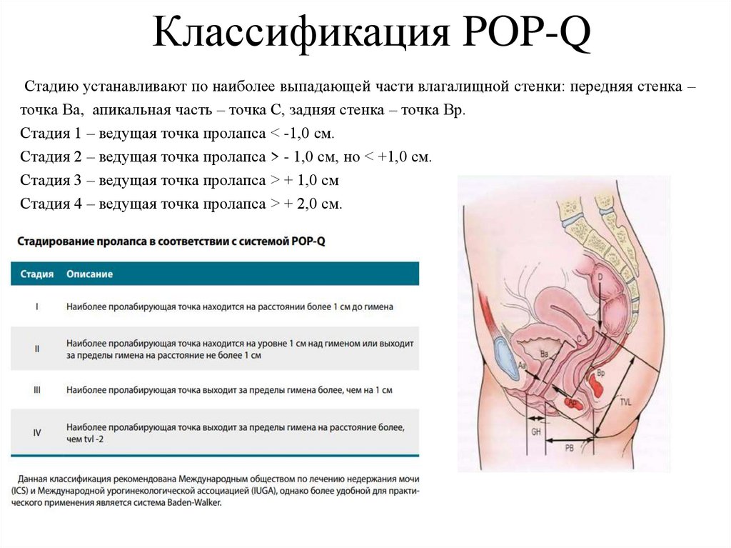 Классификация POP-Q