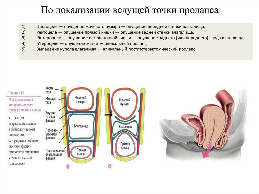 По локализации ведущей точки пролапса: