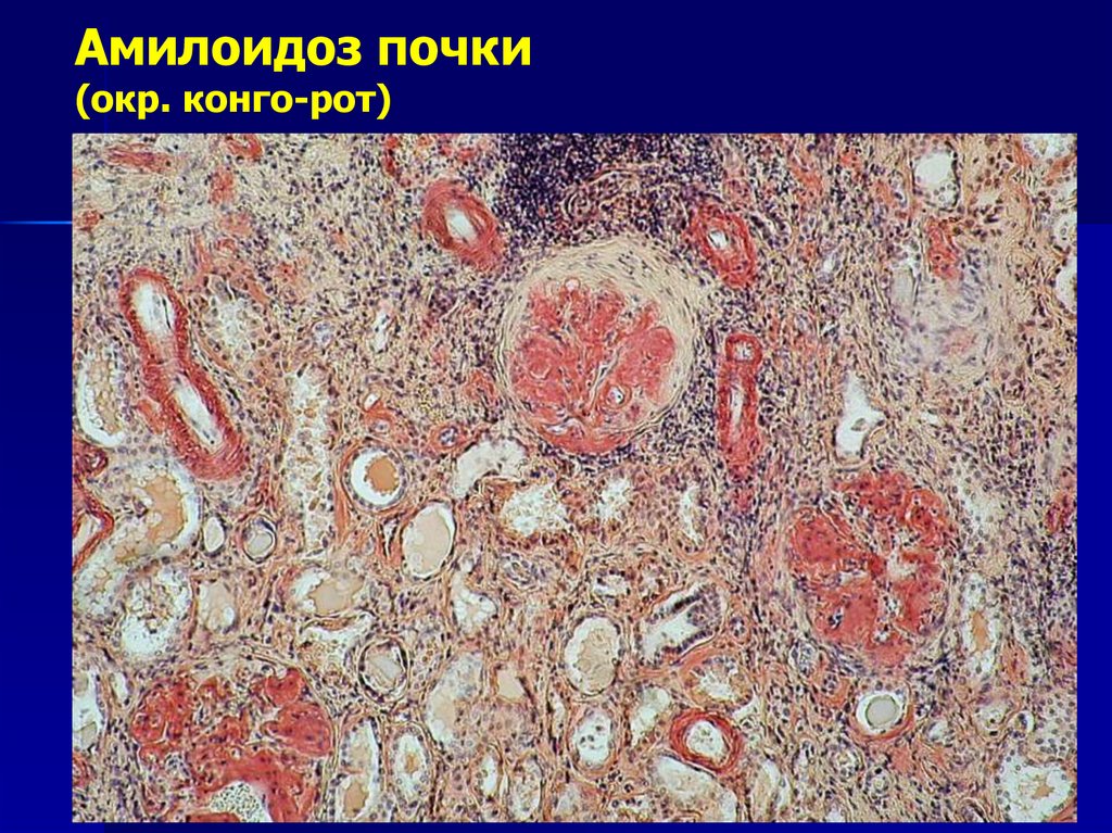 АМИЛОИДОЗ СЕЛЕЗЕНКИ (саговая селезенка)