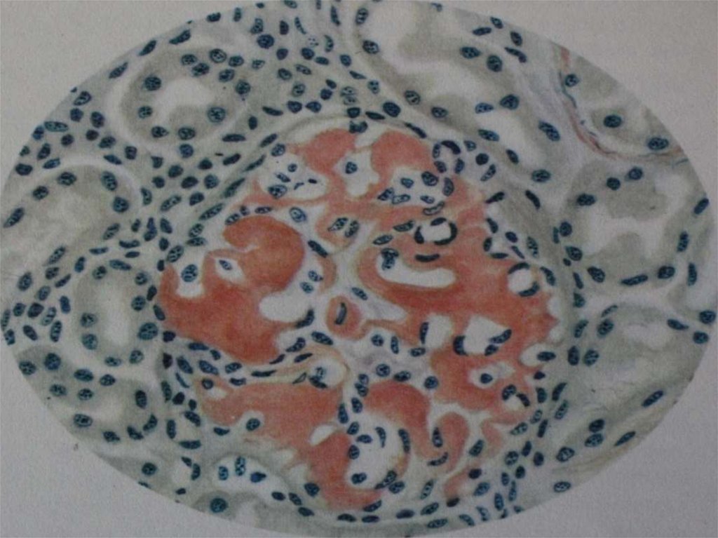 Амилоидоз селезенки (окр. конго-рот)