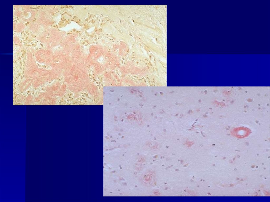 Амилоидоз почки (окр. конго-рот)