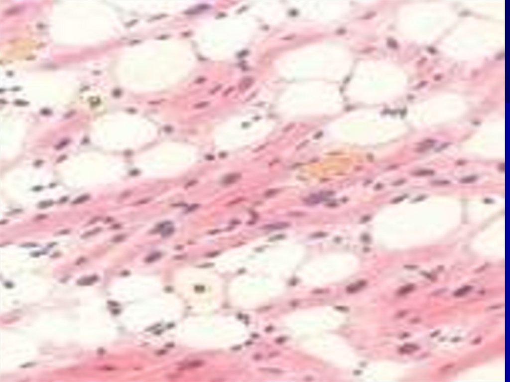 Ожирение сердца