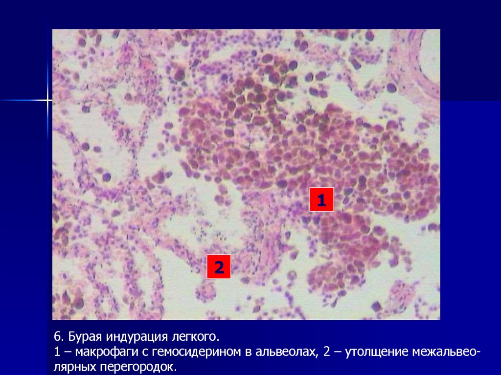 Гемосидирин -