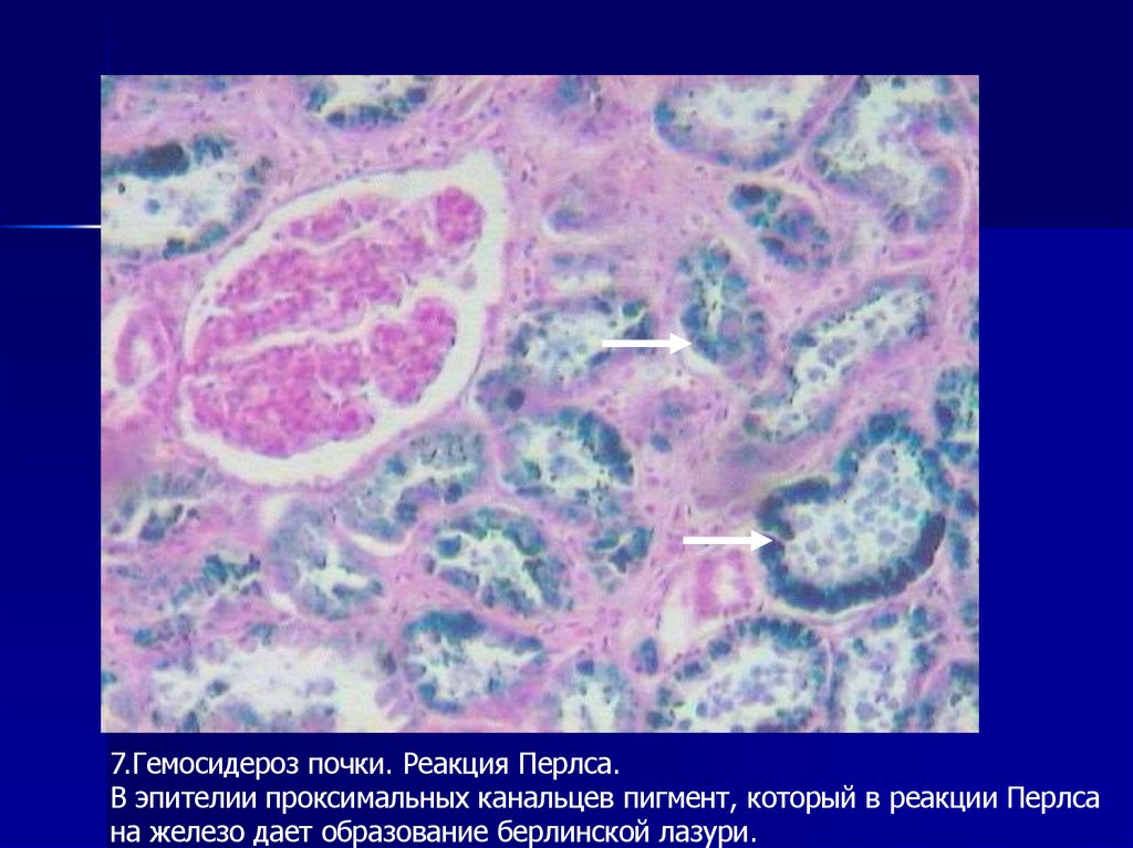 Гемосидероз бывает: