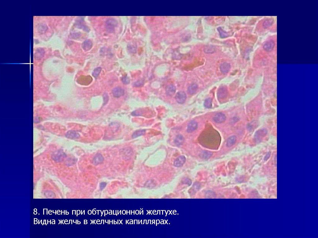 2)Печёночная (паренхиматозная)-