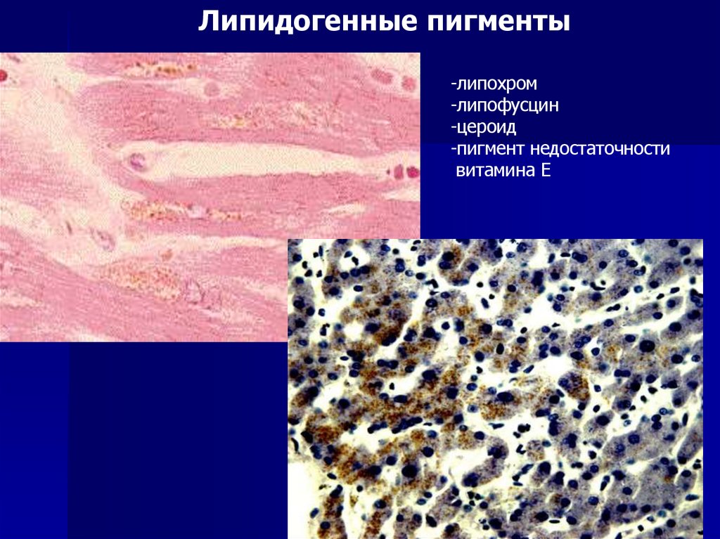 Избыток меланина в коже – меланоз: