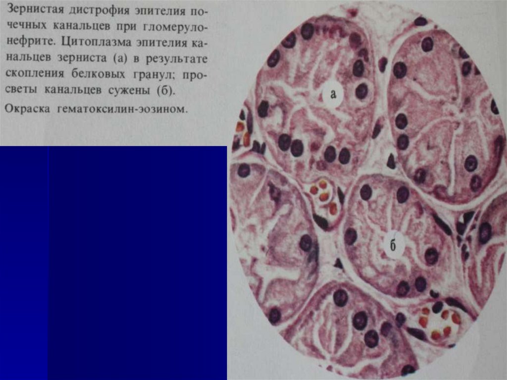 Паренхиматозные дистрофии:
