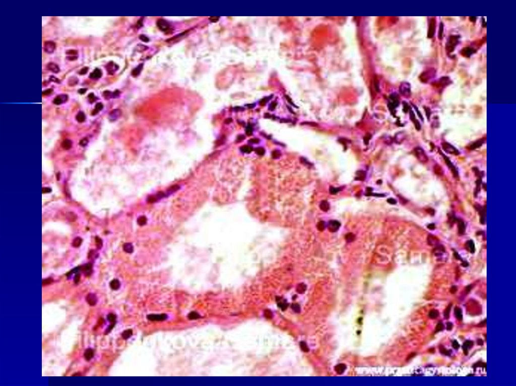 Паренхиматозные белковые дистрофии (диспротеинозы):