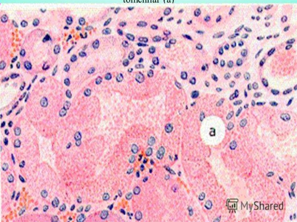 Гиалиново-капельная
