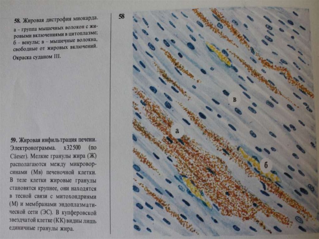 Паренхиматозная жировая дистрофия миокарда