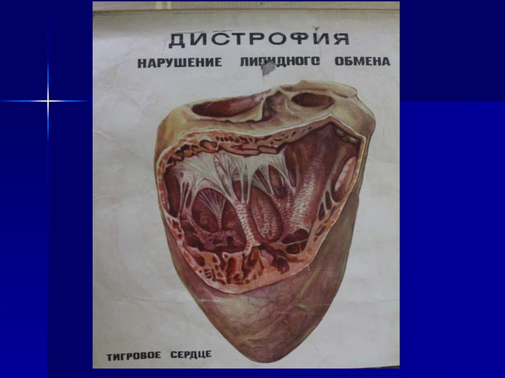 Жировая дистрофия миокарда