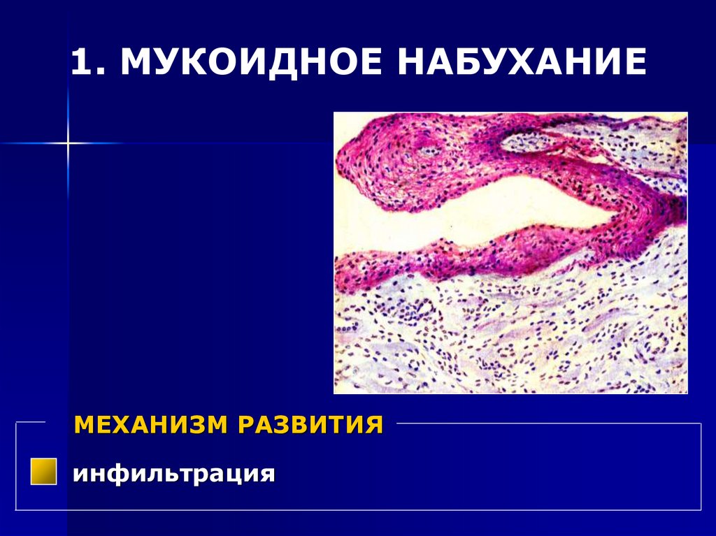 СТРОМАЛЬНО-СОСУДИСТЫЕ (МЕЗЕНХИМАЛЬНЫЕ) ДИСТРОФИИ БЕЛКОВЫЕ: