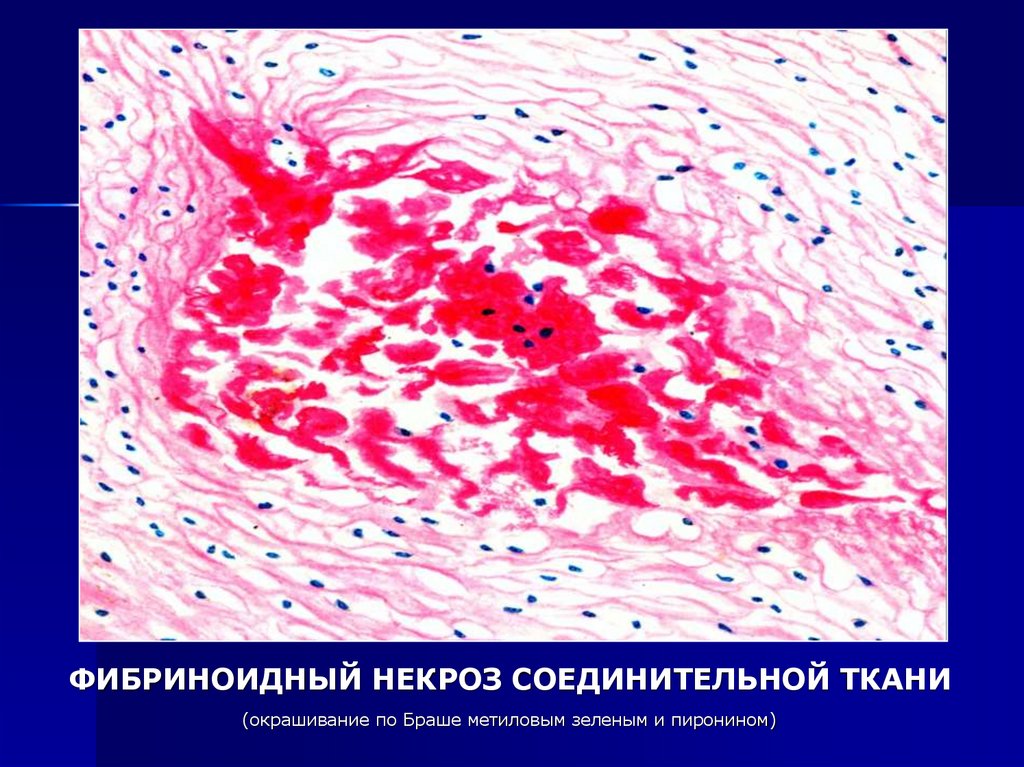 2. Фибриноидное набухание