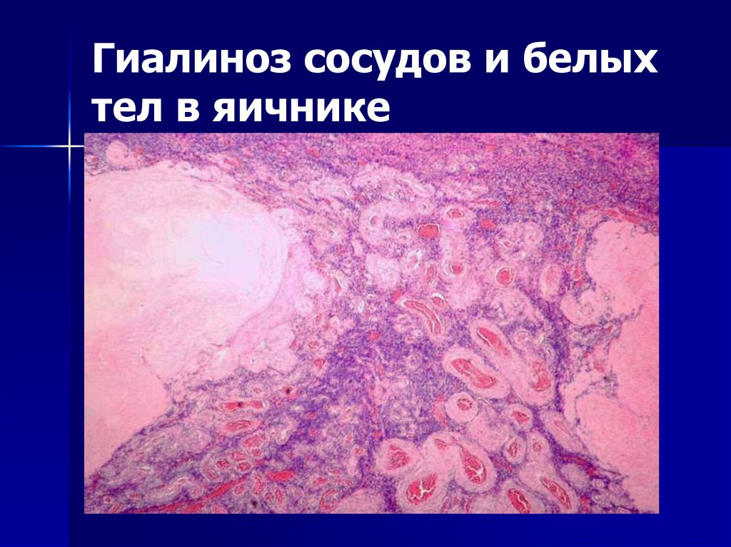 3. Гиалиноз (прозрачный, стекловидный)