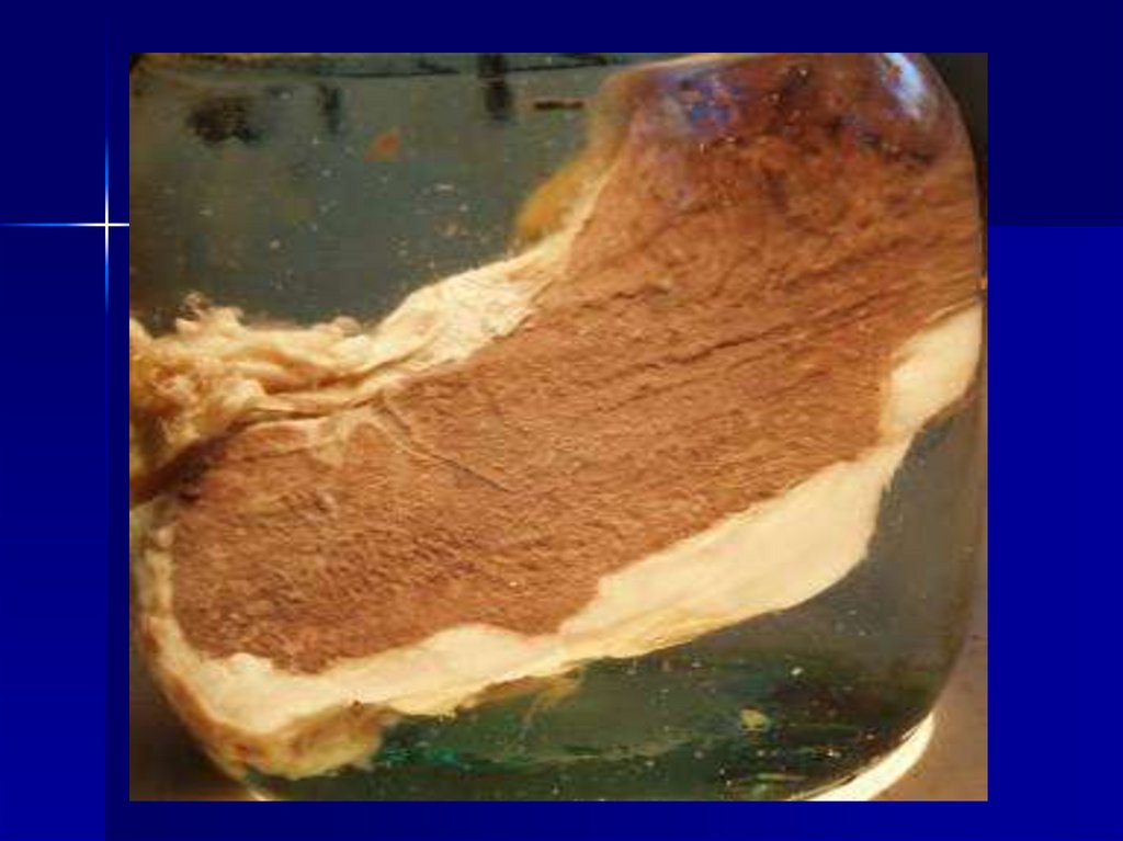 Гиалиноз сосудов и белых тел в яичнике