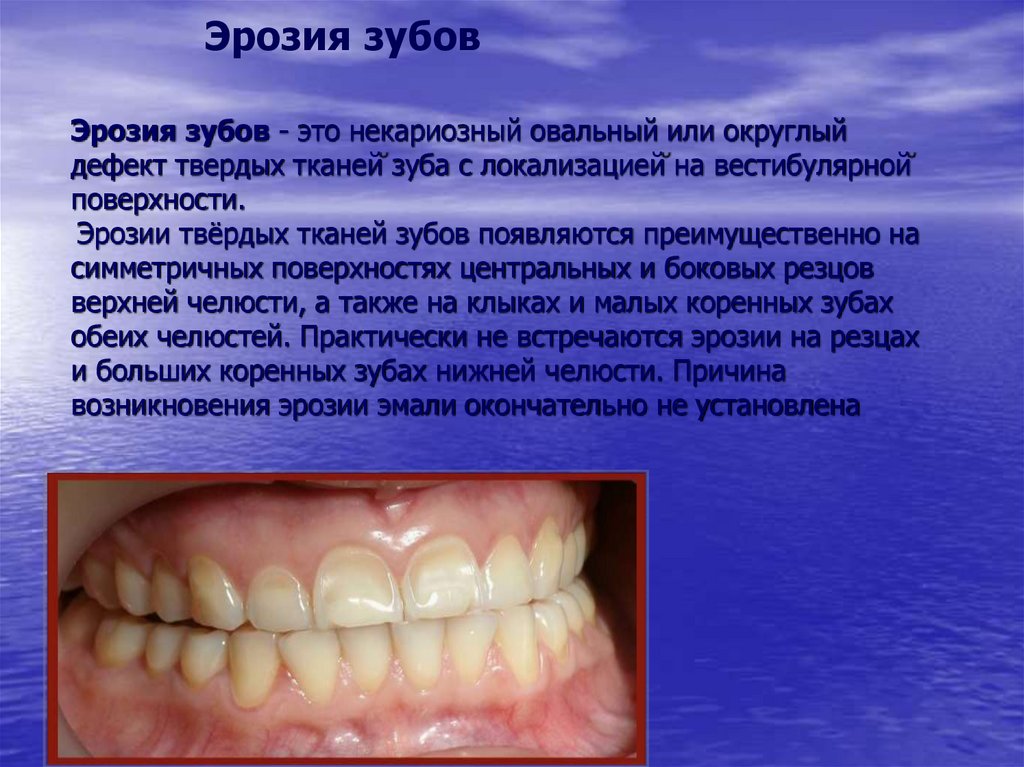 Эрозия зубов - это некариозный овальный или округлый дефект твердых тканей зуба с локализацией на вестибулярной поверхности.