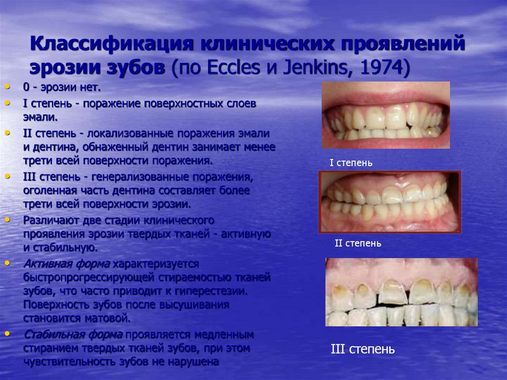 Классификация клинических проявлений эрозии зубов (по Eccles и Jenkins, 1974)