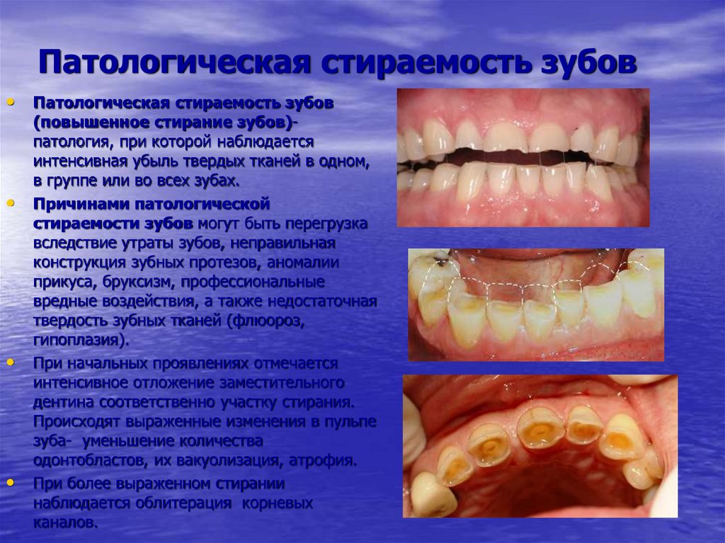 Патологическая стираемость зубов