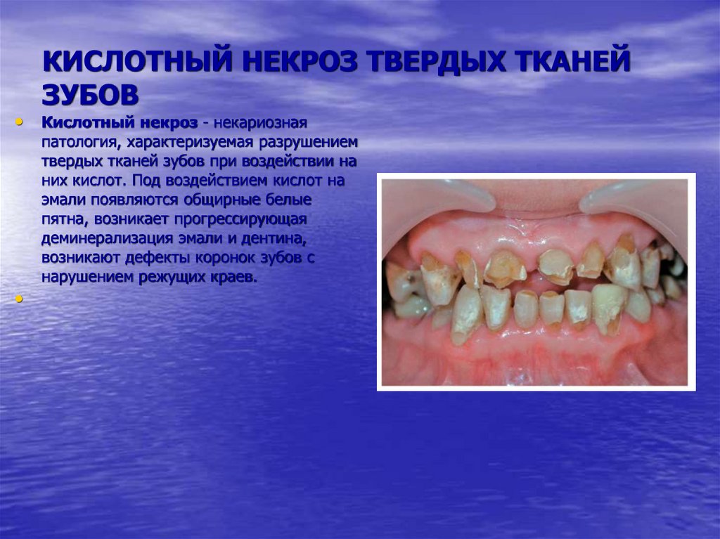 КИСЛОТНЫЙ НЕКРОЗ ТВЕРДЫХ ТКАНЕЙ ЗУБОВ