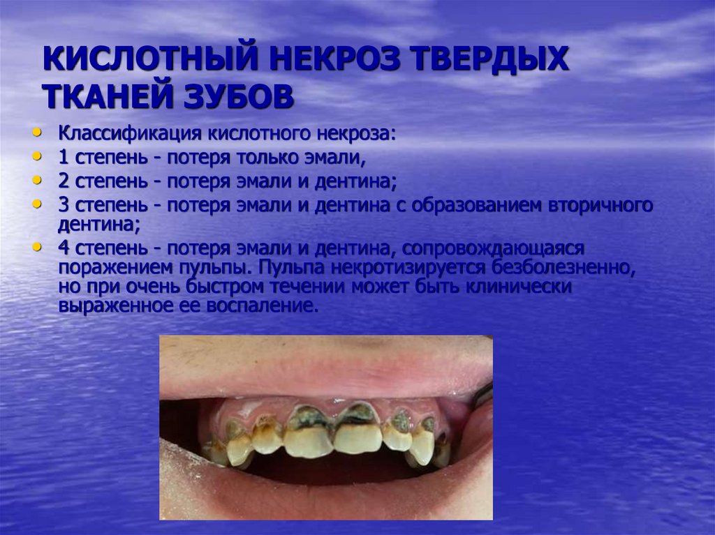 КИСЛОТНЫЙ НЕКРОЗ ТВЕРДЫХ ТКАНЕЙ ЗУБОВ