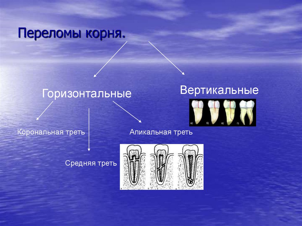 Переломы корня.
