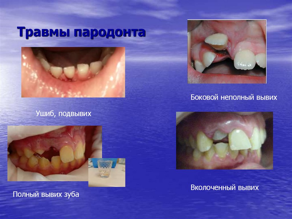 Травмы пародонта