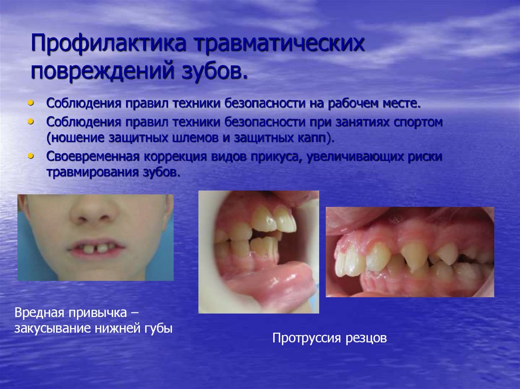 Профилактика травматических повреждений зубов.