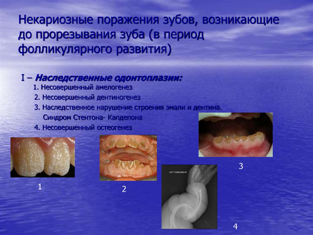Некариозные поражения зубов, возникающие до прорезывания зуба (в период фолликулярного развития)