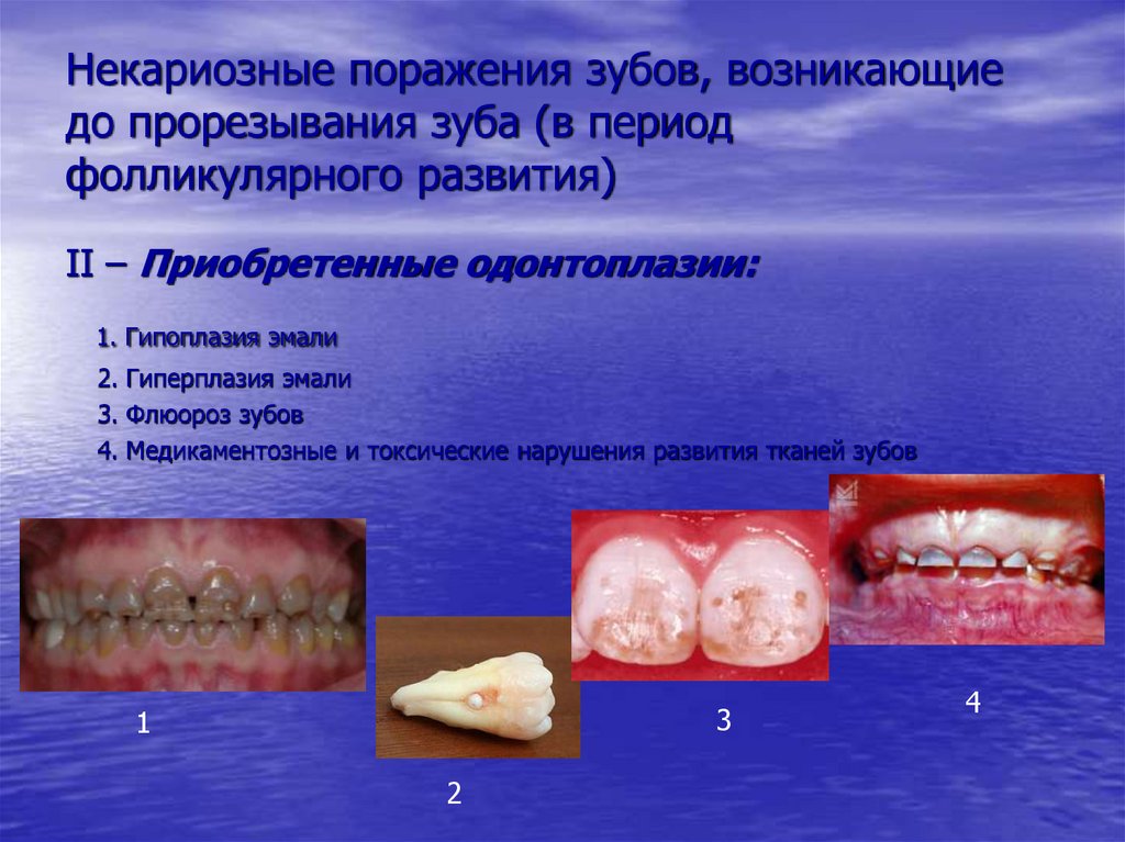Некариозные поражения зубов, возникающие до прорезывания зуба (в период фолликулярного развития)