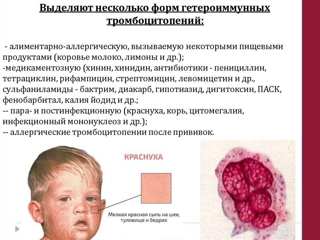 Выделяют несколько форм гетероиммунных тромбоцитопений: