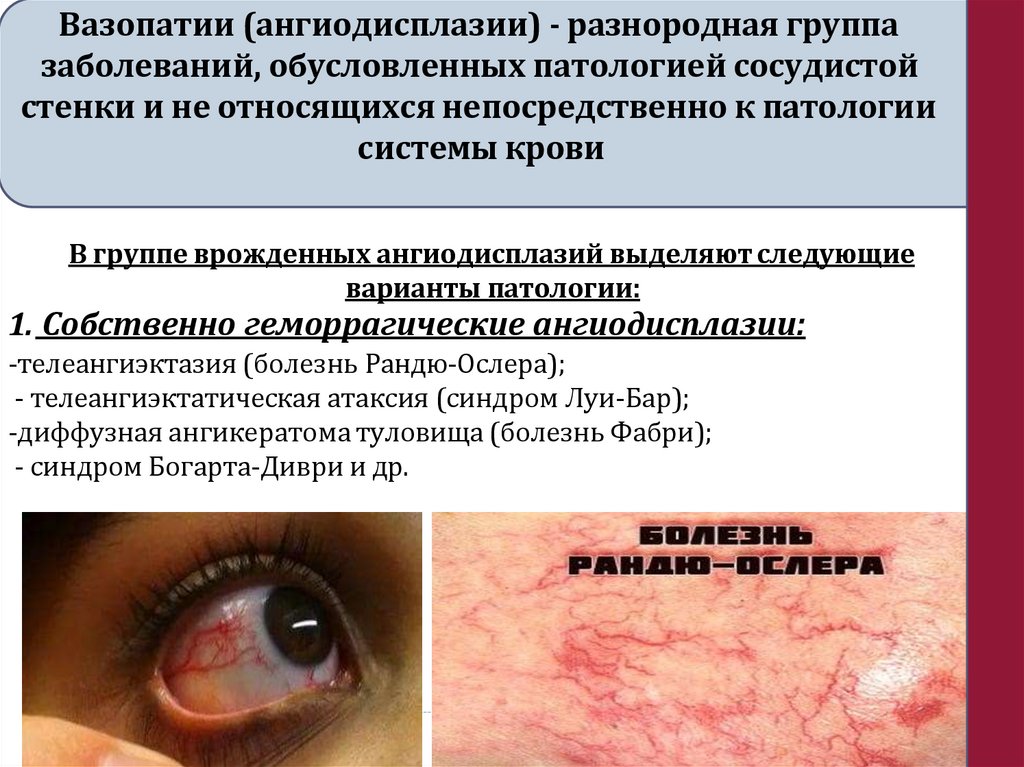Вазопатии (ангиодисплазии) - разнородная группа заболеваний, обусловленных патологией сосудистой стенки и не относящихся